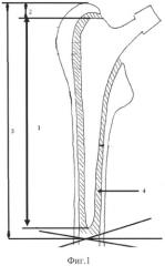 Способ имплантации бедренного компонента эндопротеза при дефектах бедренной кости (патент 2562704)