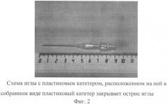 Способ проводниковой анестезии (патент 2426563)