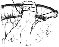 Способ защиты межкишечных анастомозов (патент 2367361)