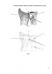 Способ лечения вывиха головки локтевой кости у детей (патент 2647178)