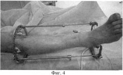 Способ временной фиксации внутрисуставных переломов дистального отдела костей голени (патент 2564080)