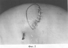 Способ пластического закрытия дефекта при хирургическом лечении меланомы кожи (патент 2250080)