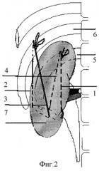 Способ хирургического лечения патологически подвижной почки (патент 2253375)