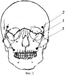 Способ остеосинтеза переломов верхней челюсти (патент 2380051)