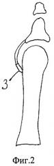 Способ оперативного лечения вальгусной деформации первого пальца стопы (патент 2269959)