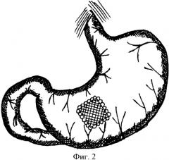 Способ ушивания перфоративных язв желудка и двенадцатиперстной кишки (патент 2363396)