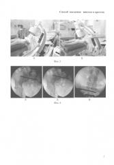 Способ введения винтов в крестец (патент 2584557)