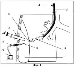 Способ селективной пломбировки бронхоплевральных свищей (патент 2269940)