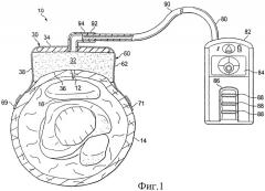 Системы сжатия и устройства пониженного давления для использования на суставе (патент 2471509)