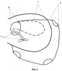 Способ комбинированной реваскуляризации головного мозга при болезни мойамойа (патент 2522917)