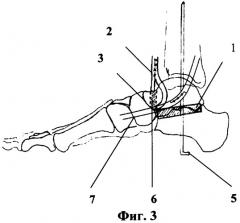 Способ хирургического лечения плосковальгусной деформации стопы у детей с детским церебральным параличом (патент 2345727)