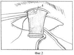Способ хирургического лечения птоза верхнего века (патент 2360653)