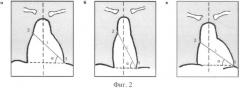 Способ автоматического определения размеров и положения сердца пациента по флюорографическим снимкам (патент 2372844)