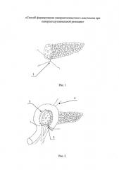 Способ формирования панкреатокишечного анастомоза при панкреатодуоденальной резекции (патент 2632767)