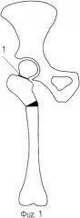 Способ эндопротезирования тазобедренного сустава при углообразной деформации диафиза бедра (патент 2342912)