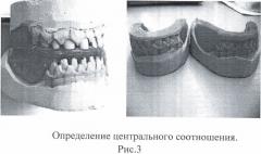 Способ протезирования встречных концевых дефектов зубных рядов (патент 2432117)