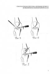 Способ лечения перелома межмыщелкового возвышения большеберцовой кости (патент 2640945)