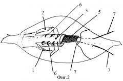 Способ пластики ахиллова сухожилия (патент 2340301)