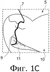 Динамическая визуализация информации о состоянии коронарных сосудов и перфузии миокарда (патент 2530665)