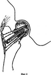 Способ лечения ложного сустава шейки и остеонекроза головки бедренной кости (патент 2328238)
