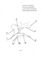 Способ устранения послеоперационного латерального смещения тимпанальной мембраны (патент 2648177)