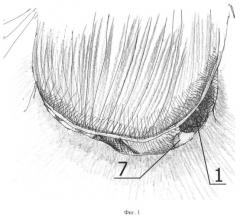 Способ удаления параганглиомы латерального основания черепа отиатрической формы (патент 2464937)