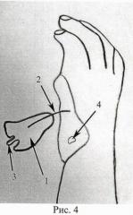 Способ реконструкции первого пальца кисти у детей с врожденной гипоплазией первого пальца кисти (патент 2471444)