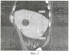 Способ дифференциальной диагностики метастатического поражения паренхимы печени при раке легкого и толстой кишки (патент 2407436)
