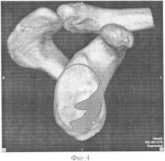 Способ восстановления дефекта переднего края суставной впадины лопатки при хронической рецидивирующей передней нестабильности плечевого сустава (патент 2573803)