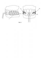 Способ снижения избыточного веса и внутриротовое устройство для его осуществления (патент 2644548)