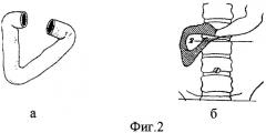 Способ эндоскопической диагностики при различных формах двенадцатиперстной кишки (патент 2320255)