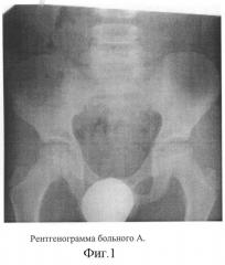 Способ диагностики остеохондропатии тазобедренного сустава (патент 2257573)