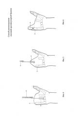 Способ реконструкции локтевой противоупорной бранши (патент 2585738)