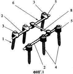 Устройство для проведения стабилизирующей операции на позвоночнике (его варианты) и способ проведения стабилизирующей операции на позвоночнике (патент 2285483)