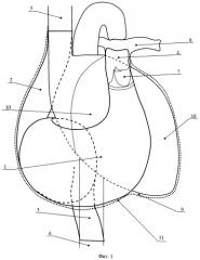 Перекачивающее устройство для правых отделов сердца при сложных врожденных пороках сердца, требующих проведения операции фонтена-правый неожелудочек (патент 2523700)
