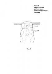 Способ хирургической реабилитации колостомированных больных (патент 2618202)
