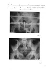 Способ лечения полифокальных нестабильных повреждений тазового кольца с открытыми переломами в пределах переднего полукольца и расхождением симфиза (патент 2578099)