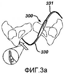 Имплантаты и способы для восстановления тазового дна (патент 2484787)