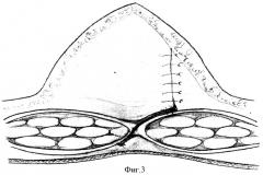 Способ хирургического лечения при диастазах прямых мышц живота (патент 2393789)