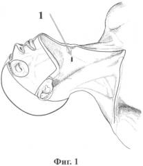 Способ остеосинтеза поврежденного зубовидного отростка второго шейного позвонка (патент 2551226)