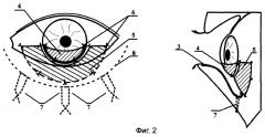 Способ хирургического лечения симблефарона (патент 2258493)