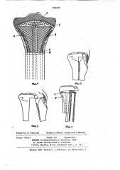 Система крепления эндопротеза диафиза кости (патент 606239)