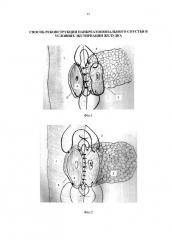 Способ реконструкции панкреатоеюнального соустья в условиях экстирпации желудка (патент 2641167)