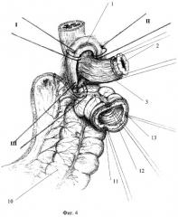 Способ толстокишечной гастропластики после гастрэктомии (патент 2278619)