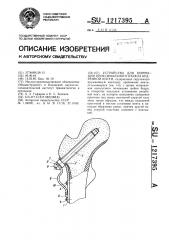 Устройство для коррекции проксимального отдела бедренной кости (патент 1217395)