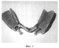 Способ восстановления ретенционных свойств зубных протезов (патент 2463992)