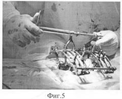 Способ устранения застарелых деформаций позвоночника (патент 2345729)