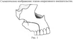 Способ хирургического лечения остеонекроза верхней челюсти (патент 2559915)