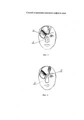 Способ устранения сквозного дефекта носа (патент 2580661)