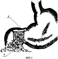 Способ ушивания перфоративных язв желудка и двенадцатиперстной кишки (патент 2310401)